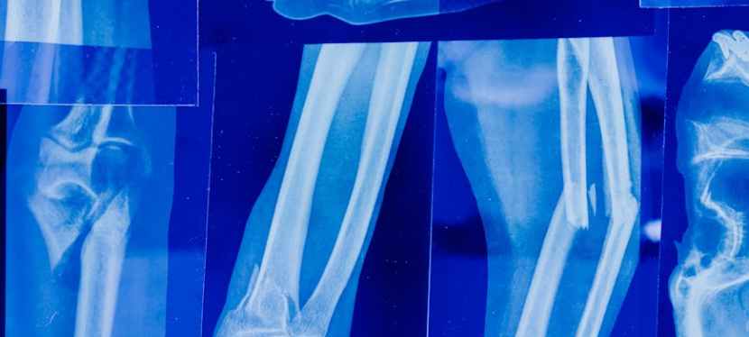 10 Tips for Reducing the Risk of Sustaining an Elbow&nbsp;Injury