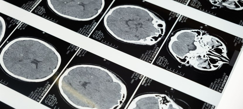 Signs an Aging Parent May Need a Cognitive&nbsp;Test
