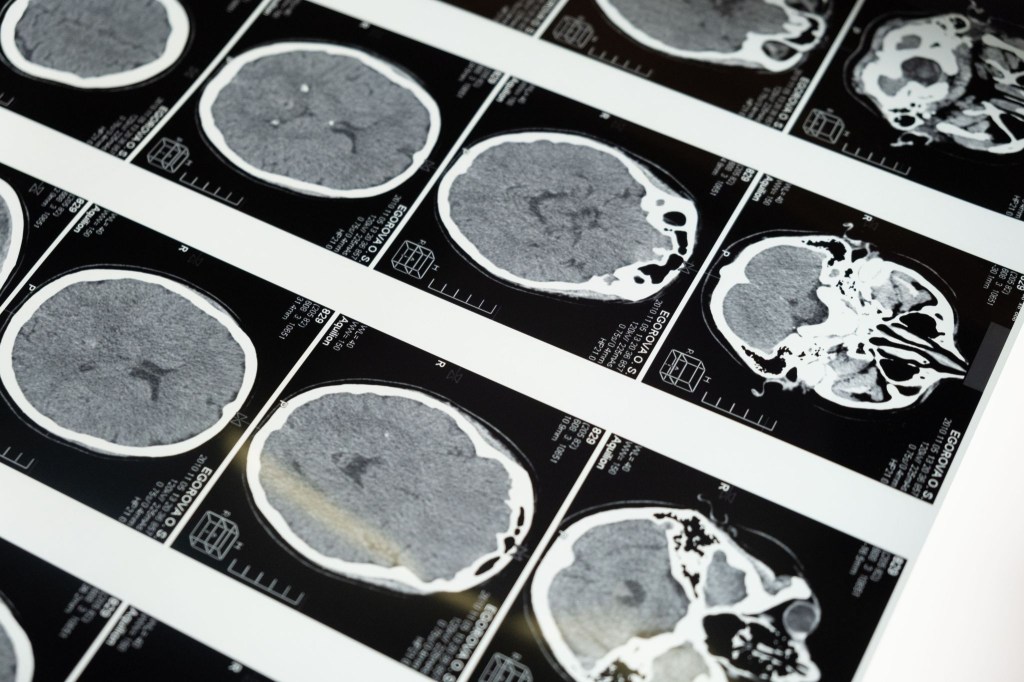 A series of black and white CT scan images of the human brain, showcasing multiple axial views for medical analysis.
